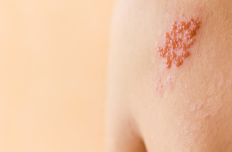 Bệnh zona thần kinh có ảnh hưởng đến thai nhi không? 1