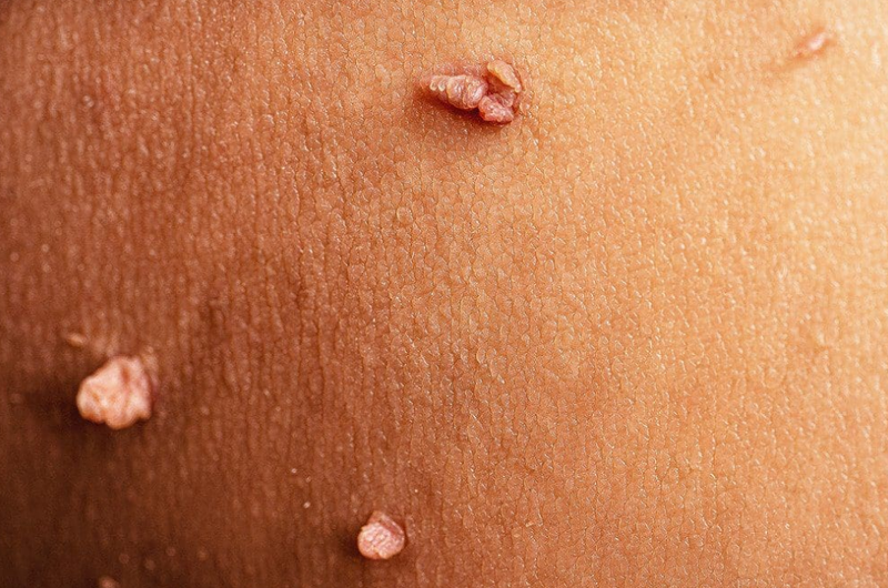 Bị sùi mào gà có lấy vợ được không? Những lưu ý trước khi cưới bạn cần biết 1