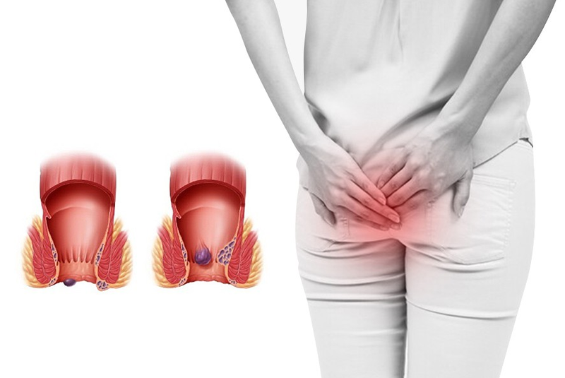 Bị trĩ có nên chạy bộ không? Nên chạy như thế nào cho đúng? 2