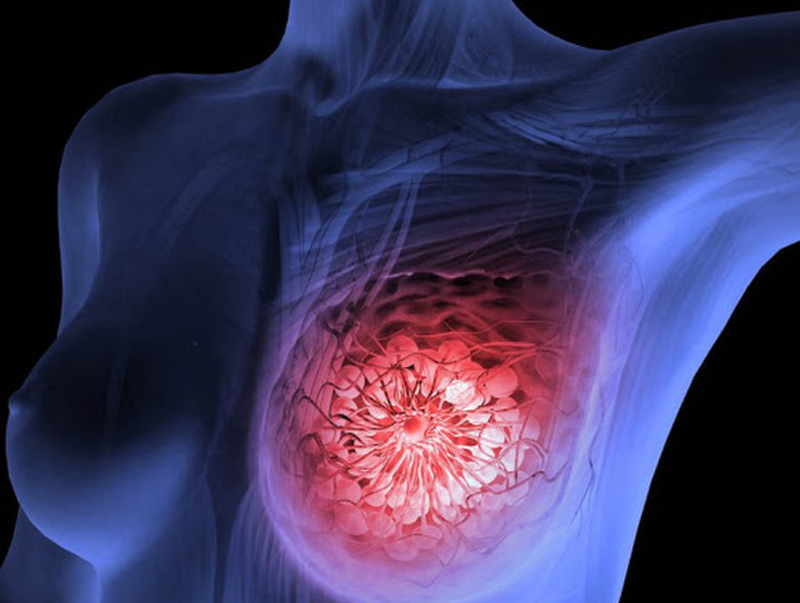 Bố mẹ bị ung thư con có bị không? Ung thư di truyền là gì? 2