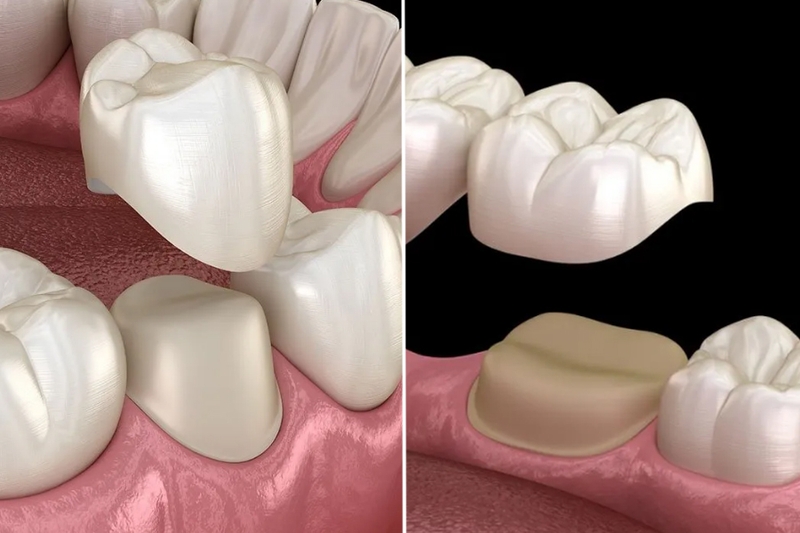 Bọc răng sứ có phải nhổ răng không? Những trường hợp ngoại lệ cần lưu ý 1