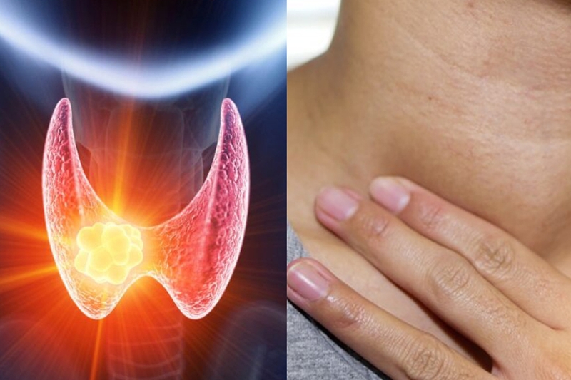 Các triệu chứng u tuyến giáp bạn không nên chủ quan và phương pháp điều trị 1
