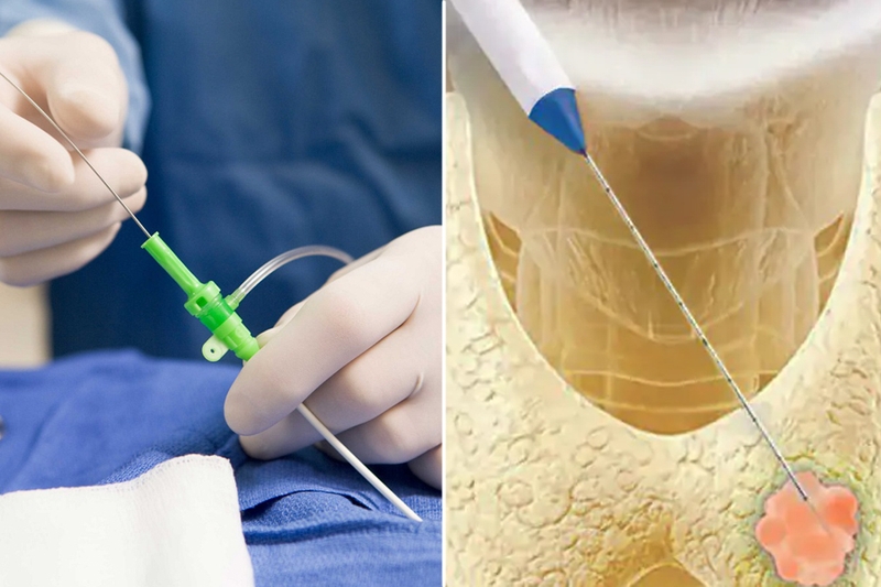 Các triệu chứng u tuyến giáp bạn không nên chủ quan và phương pháp điều trị 4