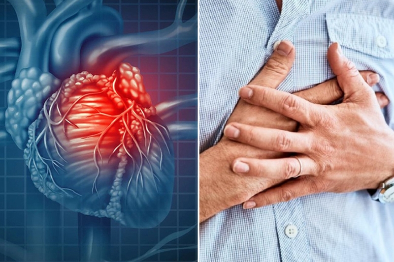 Các vùng nhồi máu cơ tim phổ biến và cách nhận diện trên ECG 1