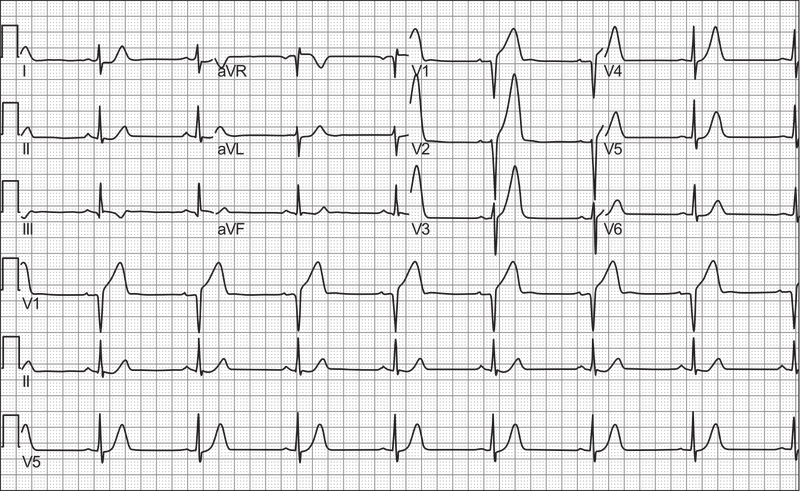 Các vùng nhồi máu cơ tim phổ biến và cách nhận diện trên ECG 2