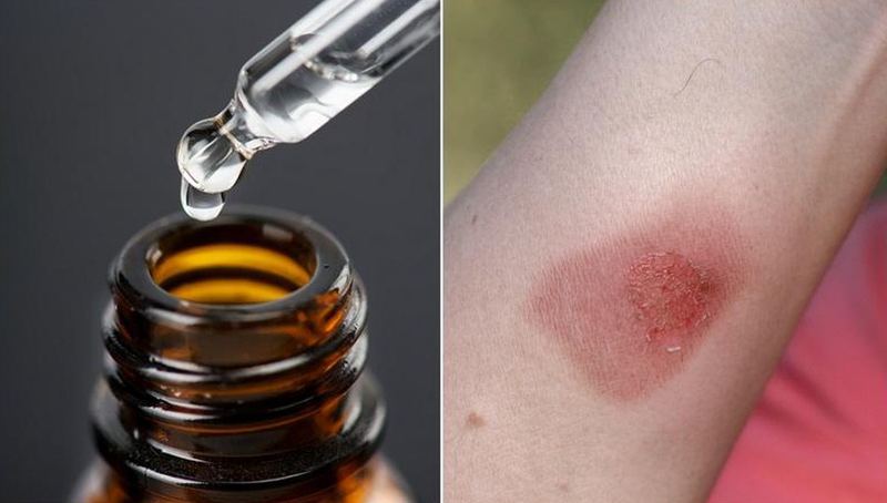 Cách chữa bỏng dầu quế và lưu ý khi dùng dầu quế 2