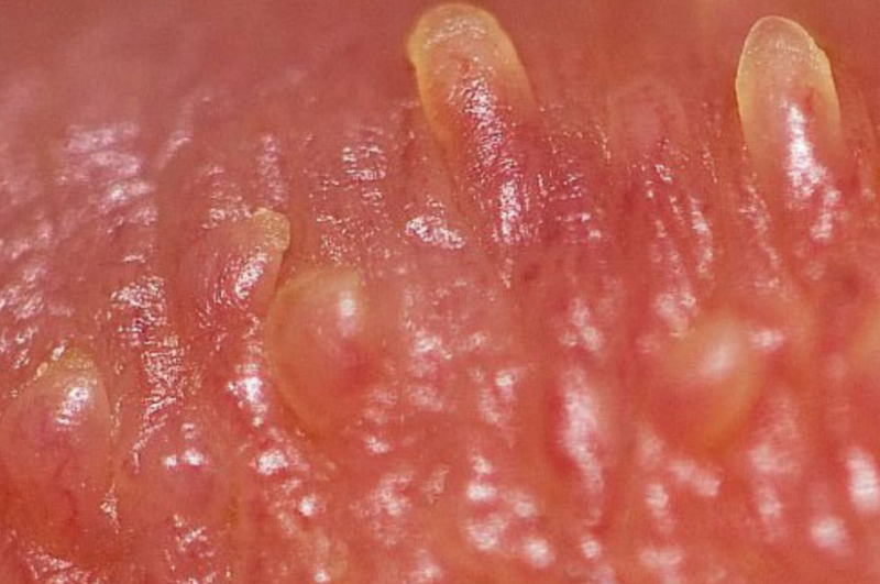 Cách đào thải virus HPV ra khỏi cơ thể triệt để 3