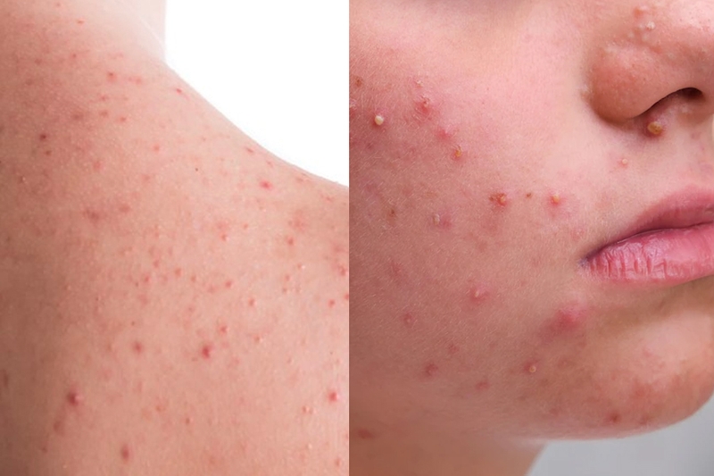 Cách phân biệt viêm nang lông và mụn trứng cá​ để điều trị hiệu quả 1