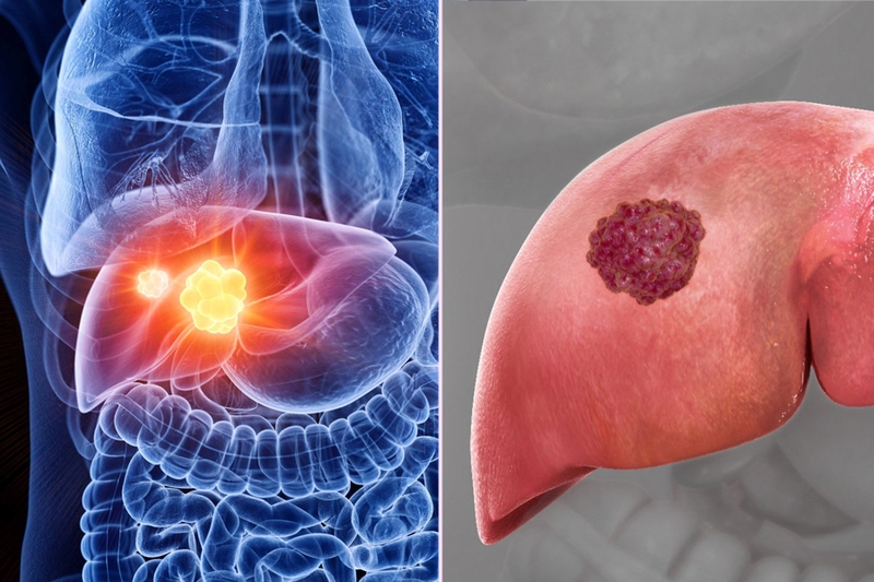 Cách phòng tránh ung thư gan đơn giản nhưng hiệu quả 1
