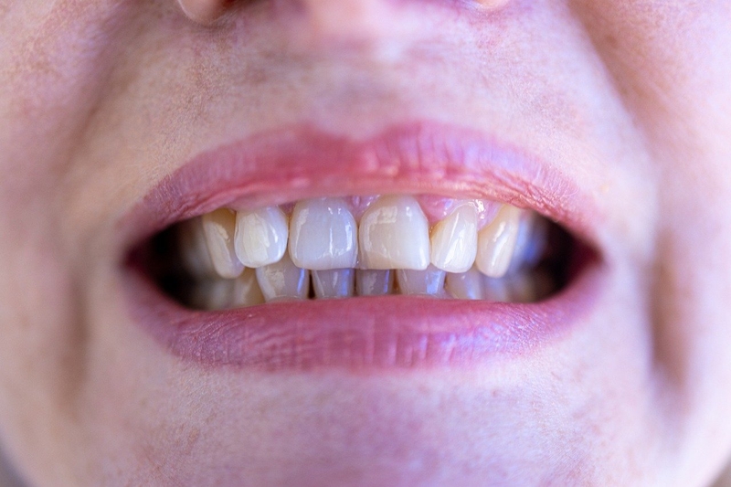 Cắm Implant bao lâu thì hết sưng? Hướng dẫn cách giảm sưng nhanh sau cấy ghép Implant 1