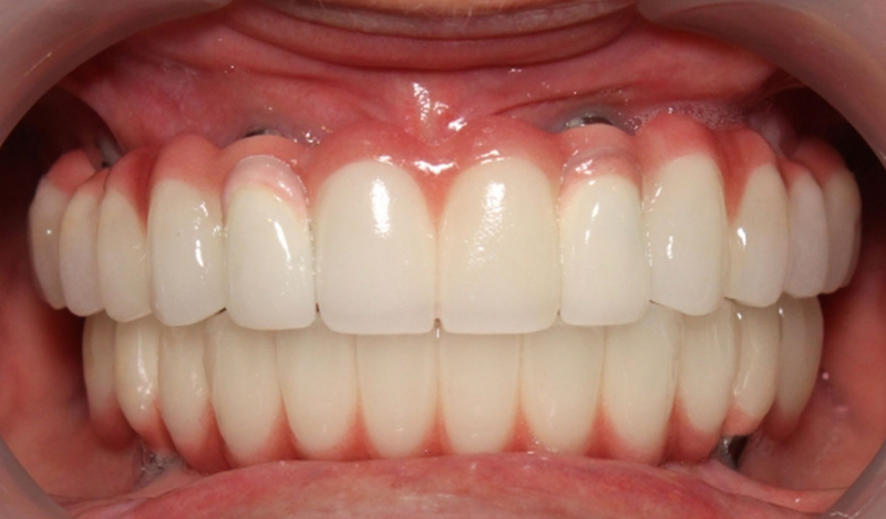 Cắm Implant bị nhức: Nguyên nhân và cách xử lý 1