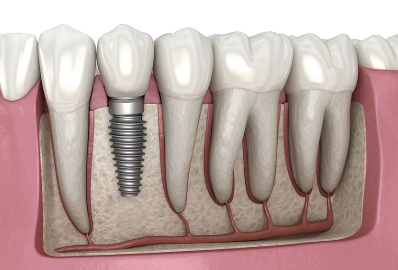 Cắm Implant bị nhức: Nguyên nhân và cách xử lý 5