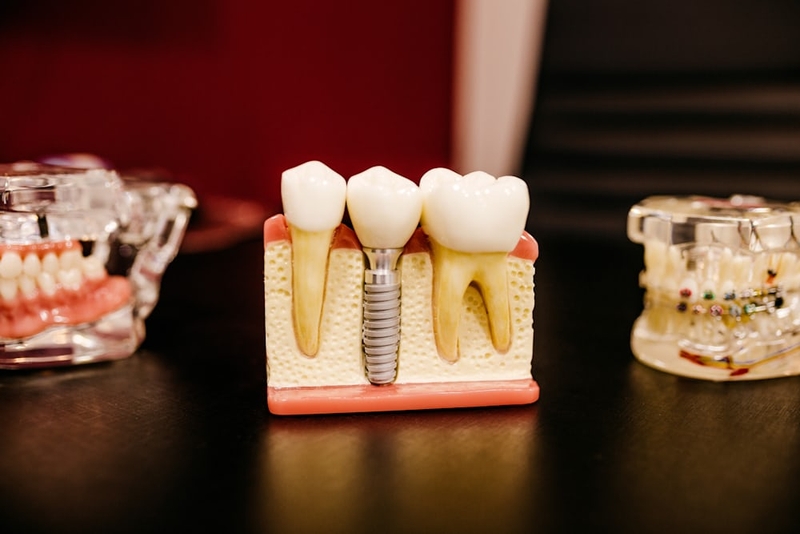 Cắm Implant bị nhức: Nguyên nhân và cách xử lý 6