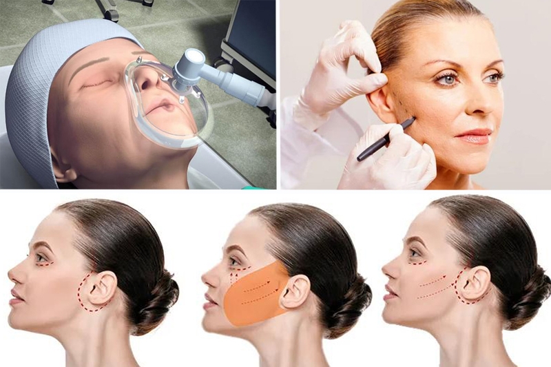 Căng da mặt truyền thống hiệu quả ra sao? Lão hóa da mức độ nào thì thực hiện? 2