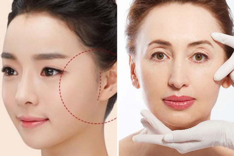 Căng da mặt truyền thống hiệu quả ra sao? Lão hóa da mức độ nào thì thực hiện? 5