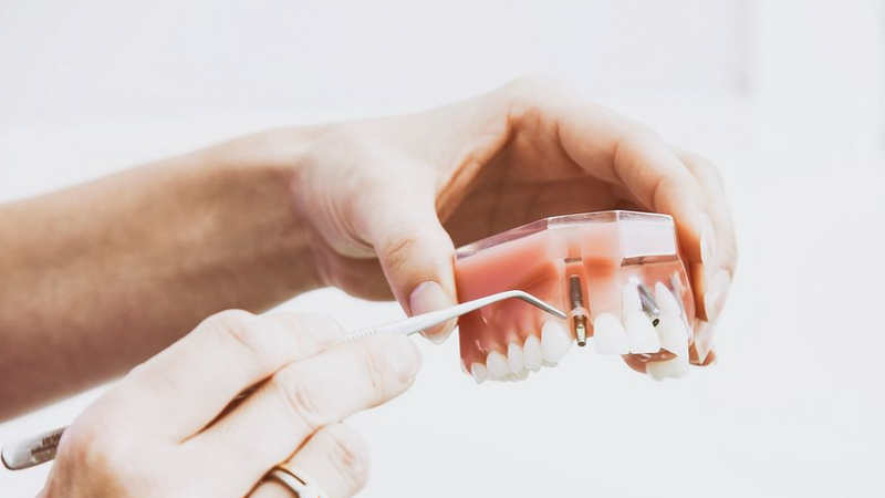 Cấy ghép implant 7 phút không đau có thật không? Hiệu quả ra sao? 1