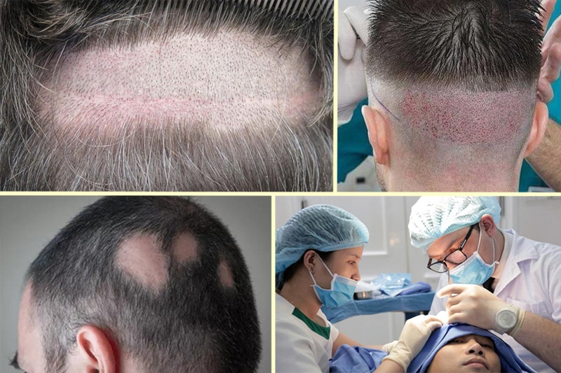 Cấy tóc sinh học là gì? Có nên thực hiện không? 1