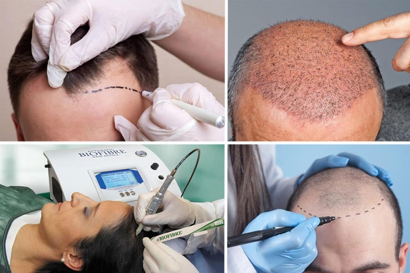 Cấy tóc sinh học là gì? Có nên thực hiện không? 2