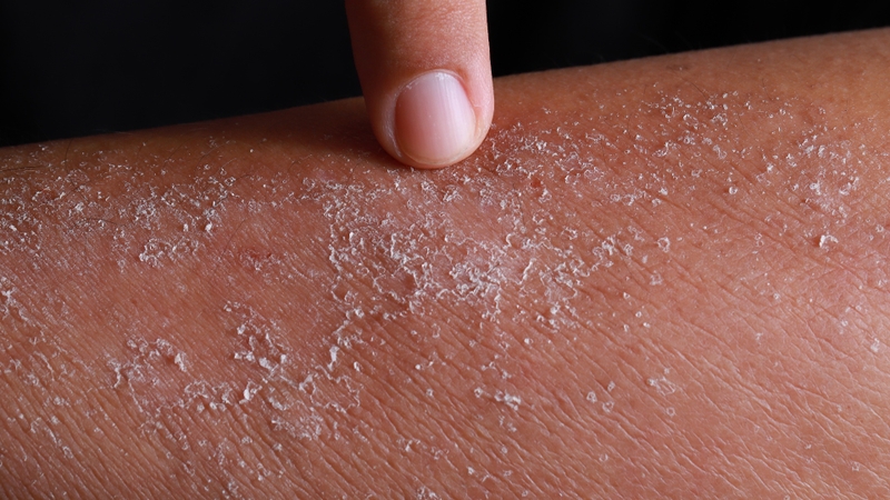 Chàm sinh dục khám ở đâu tốt?