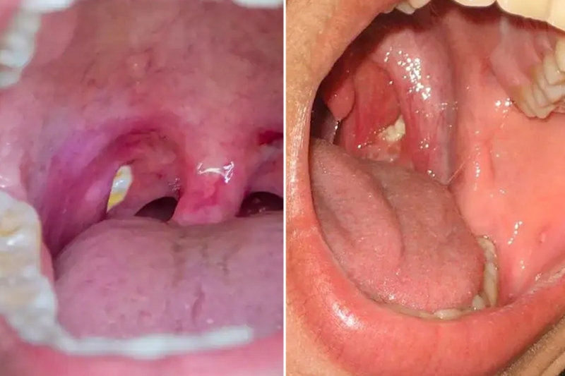 Có hạt nằm trong ngách của amidan là bị gì? Cách điều trị ra sao? 1