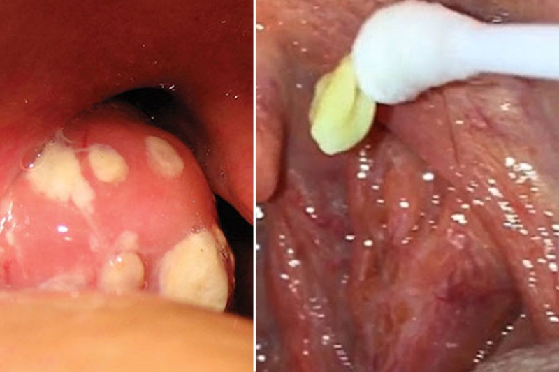 Có hạt nằm trong ngách của amidan là bị gì? Cách điều trị ra sao? 3