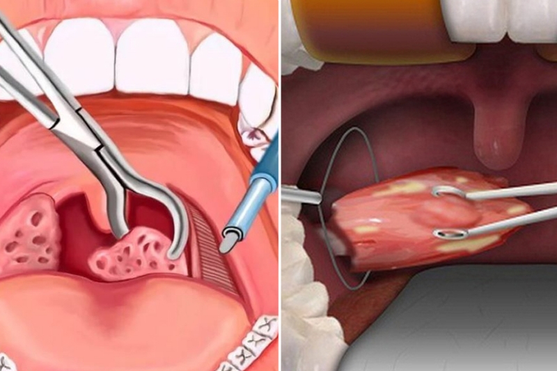 Có hạt nằm trong ngách của amidan là bị gì? Cách điều trị ra sao? 4