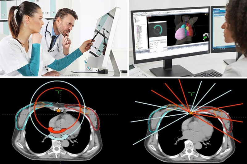 Công nghệ xạ trị RapidArc và những điều cần lưu ý khi thực hiện 5