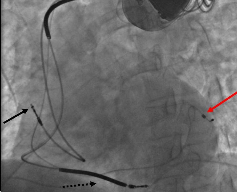 CRT trong suy tim là gì? Những lưu ý quan trọng khi thực hiện cấy ghép 1