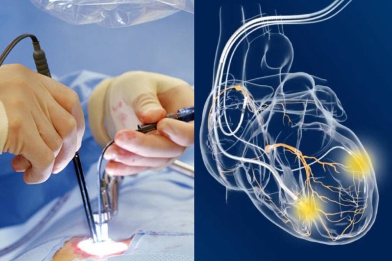 CRT trong suy tim là gì? Những lưu ý quan trọng khi thực hiện cấy ghép 4