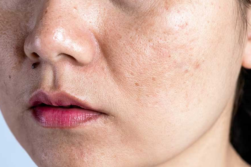 Da nổi đốm nâu không ngứa là do nguyên nhân nào? 1