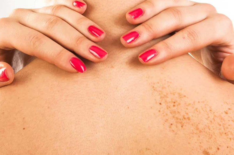 Da nổi đốm nâu không ngứa là do nguyên nhân nào? 2