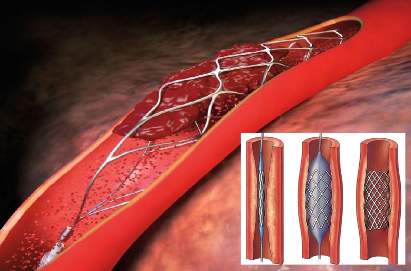 Đặt stent nhồi máu cơ tim khi nào được chỉ định? Có rủi ro hay không? 1