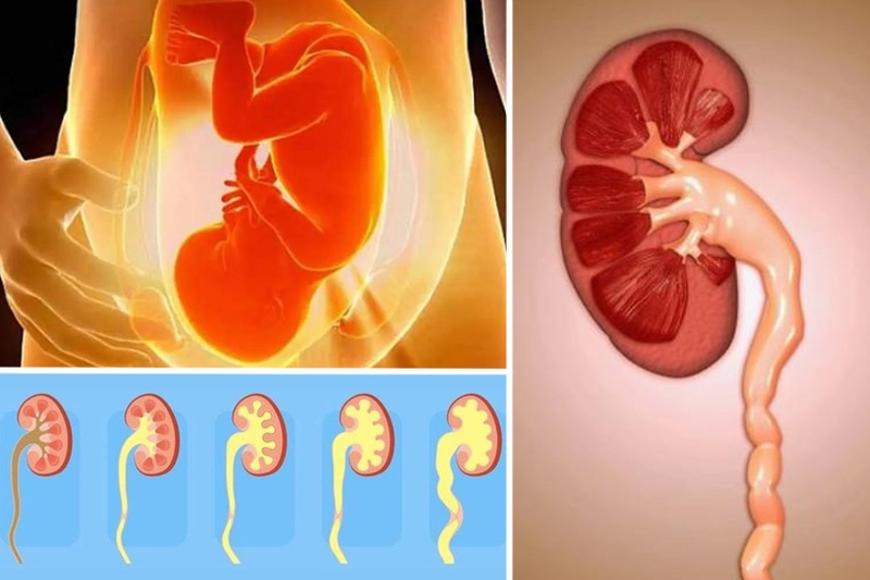 Dị tật bẩm sinh đường tiết niệu thường gặp và những điều mẹ cần biết 1