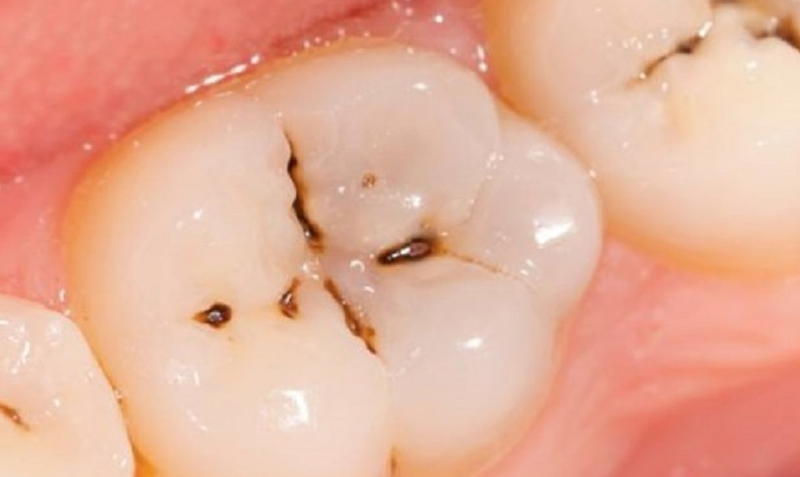 Đốm nâu trên răng là hiện tượng gì? Làm cách nào loại bỏ? 2