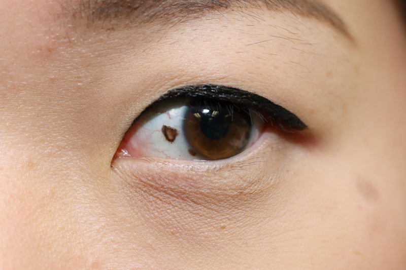 Đốm nâu trong mắt là gì? Do những nguyên nhân nào gây ra? 1