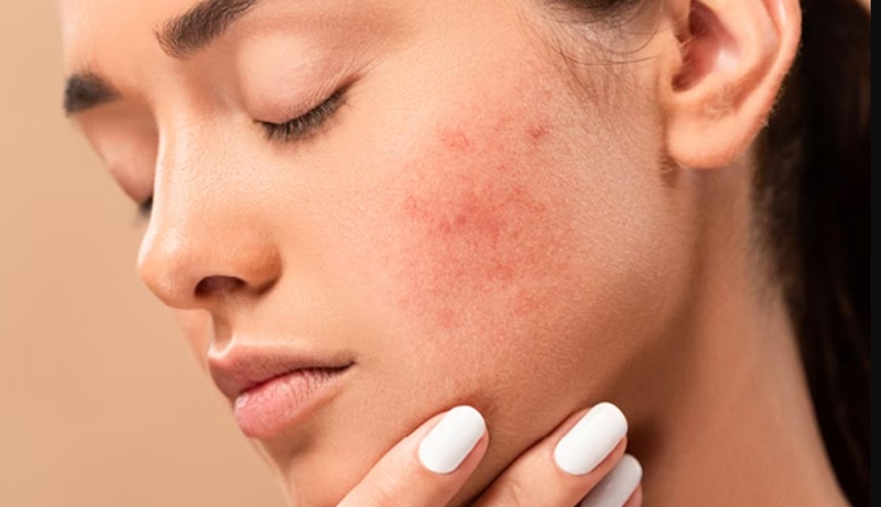 Dùng sữa rửa mặt cetaphil bị nổi mụn là do nguyên nhân gì? 1