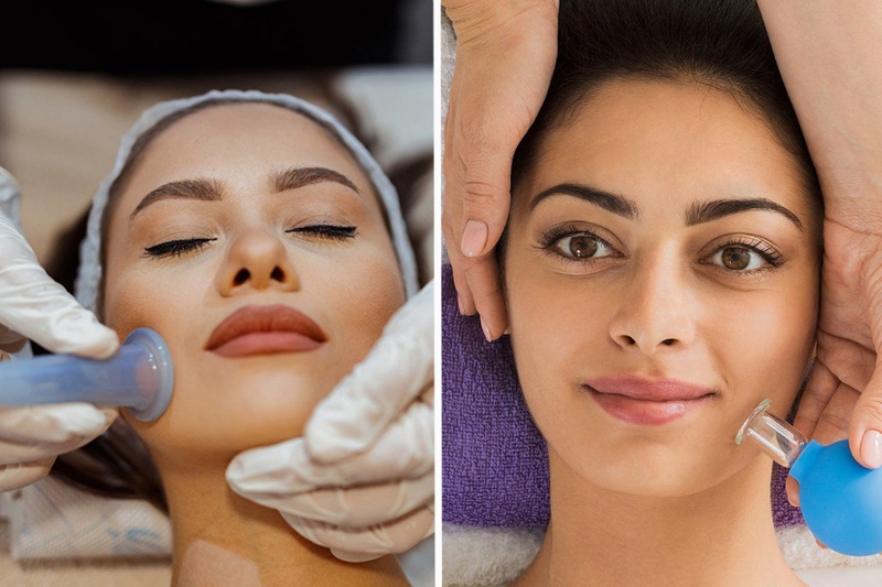 Facial cupping là gì? Lợi ích của facial cupping đối với làn da 1