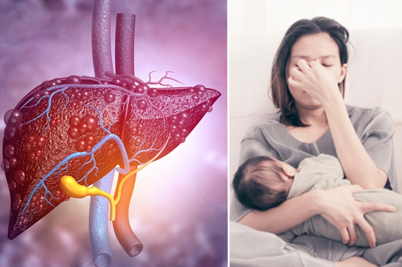 Gan nhiễm mỡ sau sinh có nguy hiểm không? Nguyên nhân và cách điều trị 1