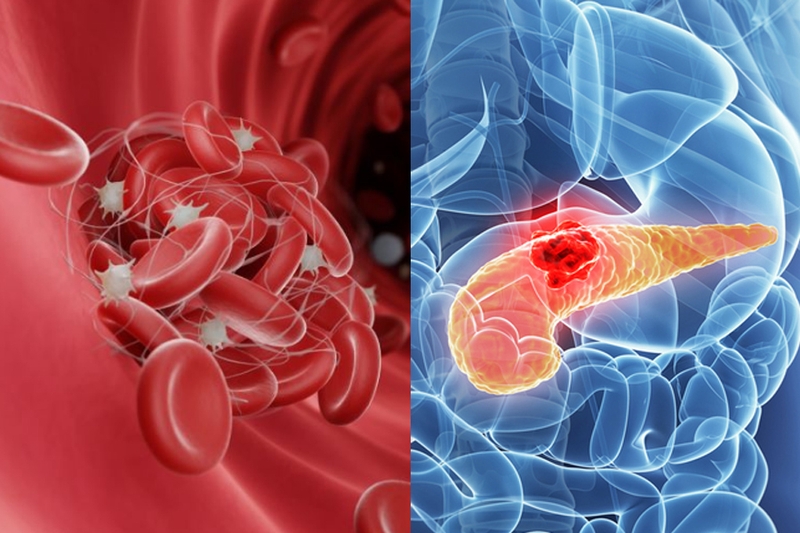 Gan nhiễm mỡ sau sinh có nguy hiểm không? Nguyên nhân và cách điều trị 4