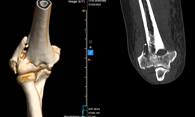 Gãy chỏm xương quay là do đâu? Cách điều trị thế nào? 3