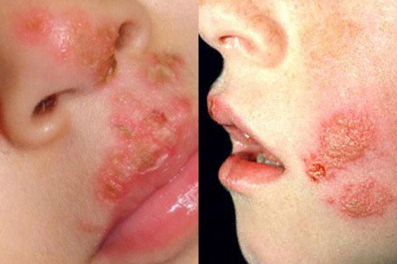 Ghẻ vùng kín là gì? Nguyên nhân, dấu hiệu và cách điều trị 3