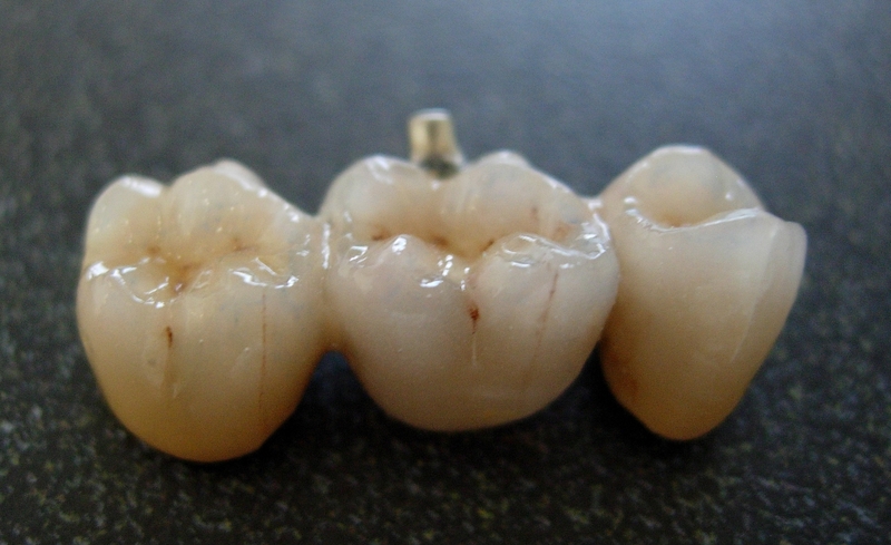 Giá răng sứ zirconia có cao không? Ưu, nhược điểm của răng sứ zirconia 4
