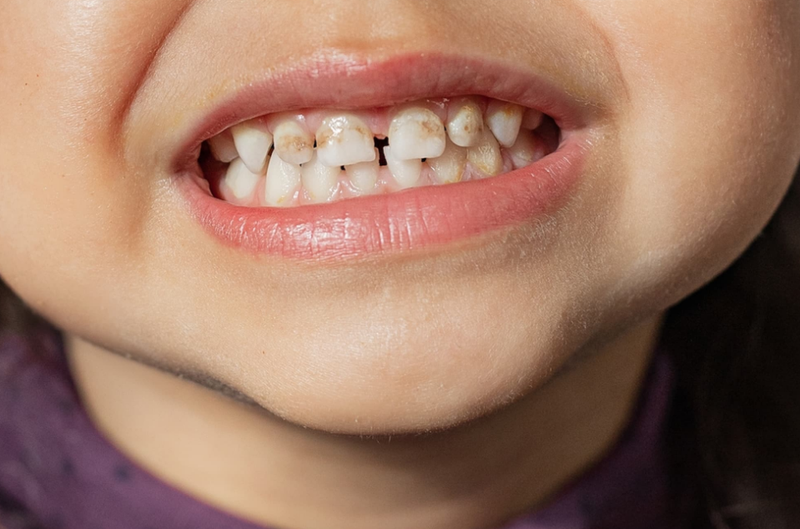 Giải đáp: Răng nhiễm kháng sinh có tẩy được không? 2