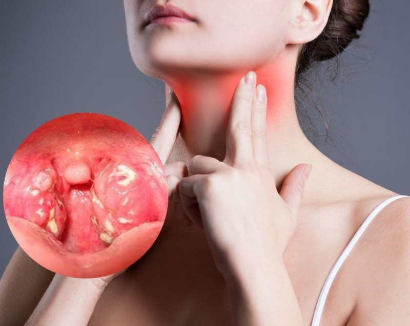 Giải đáp: Viêm amidan uống thuốc gì và cách dùng thuốc ra sao? 1