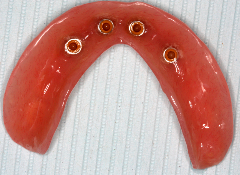 Hàm tháo lắp trên Implant là gì? Ưu, nhược điểm và các lưu ý khi sử dụng 1