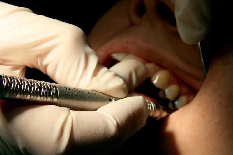 Hàm tháo lắp trên Implant là gì? Ưu, nhược điểm và các lưu ý khi sử dụng 4