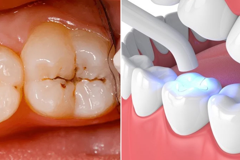 Hàn răng thẩm mỹ là gì? Những lưu ý trước và sau khi thực hiện 1