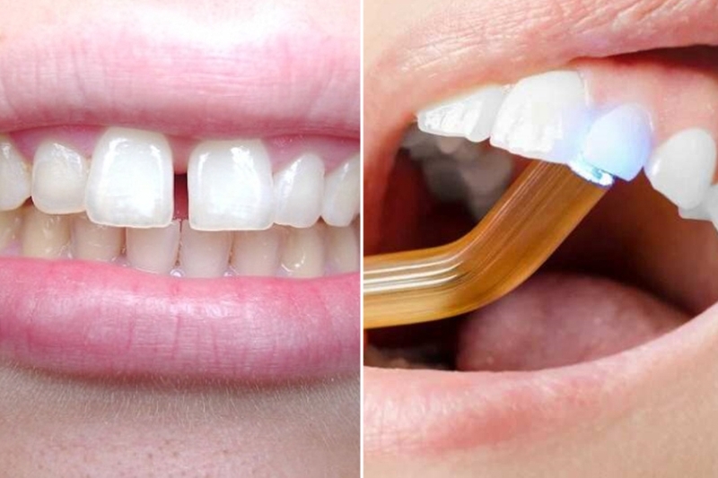 Hàn răng thẩm mỹ là gì? Những lưu ý trước và sau khi thực hiện 2