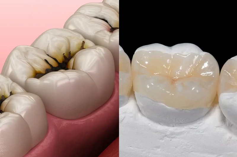 Hàn răng thẩm mỹ là gì? Những lưu ý trước và sau khi thực hiện 3