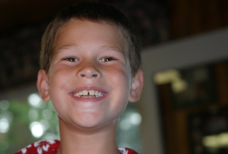 Hàn răng thưa là gì? Hướng dẫn chăm sóc răng miệng sau khi hàn răng thưa 1